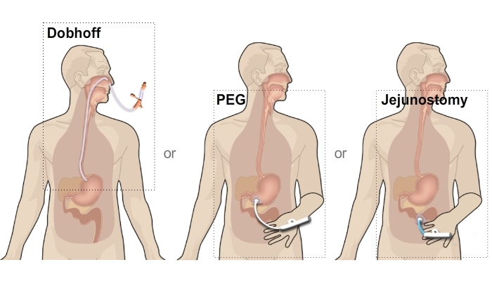 Guide Dsyphagia